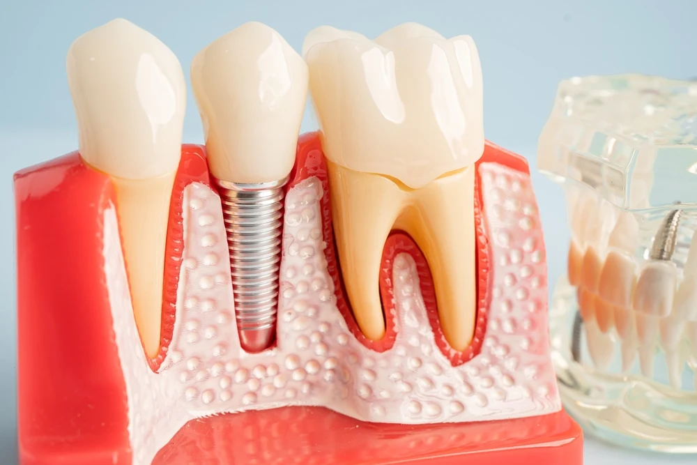 Dental Implants in Brownsville, TX
