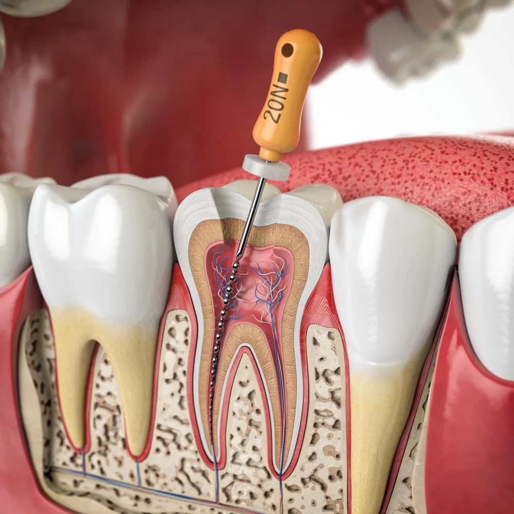 Endodontics in Brownsville, TX