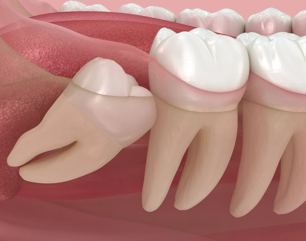 Wisdom Teeth Removal Brownsville